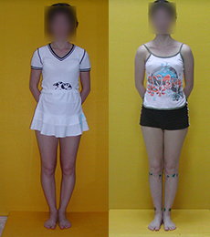 Пациент до и после выпрямления ног
