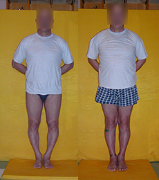 Варусная кривизна ног - до и после операции