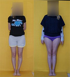 Limb lengthening by 6 cm, combined with bow legs correction. Before and after.
