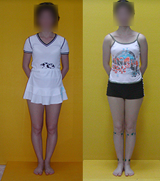 Patient before and after bow legs correction