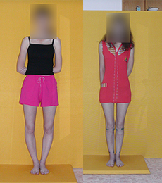 Patient before and after bow legs correction