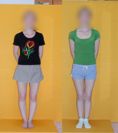 Patient before and after bow legs correction