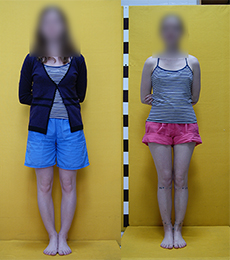 Patient before and after bow legs correction
