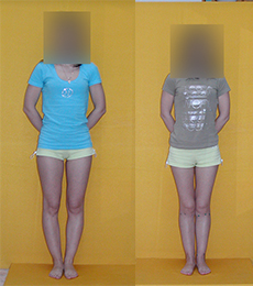 Patient before and after bow legs correction