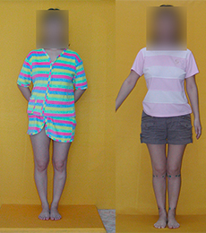 Patient before and after bow legs correction