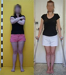 Knock knees, X-shaped legs correction