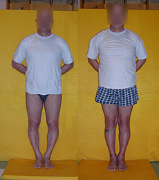 Patient before and after bow legs correction