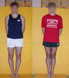 Patient before and after bow legs correction