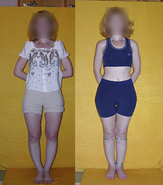 Patient before and after bow legs correction