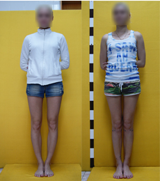 Patient before and after bow legs correction