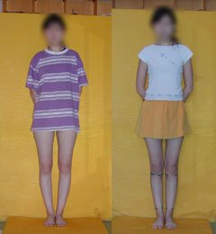 Patient before and after bow legs correction
