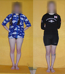 Patient before and after bow legs correction