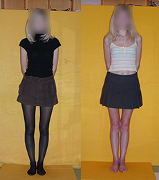 Patient before and after bow legs correction