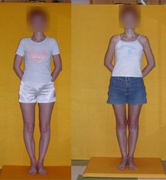 Patient before and after bow legs correction