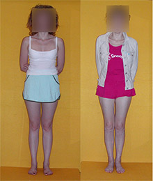 Knock knees, X-shaped legs correction