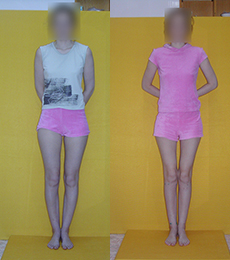 Patient before and after bow legs correction