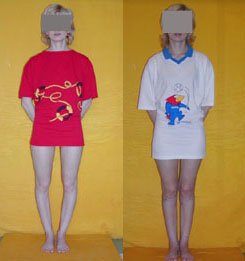 Bow legs correction. Before and after operation.
