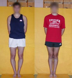 Исправление О-образной кривизны ног (коррекция формы ног) - до и после операции