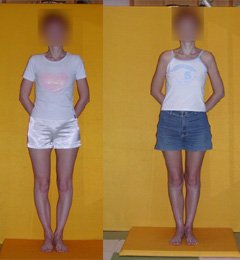 Bow legs correction. Before and after operation.