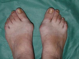 Deformations in the anterior part of the feet - before surgery