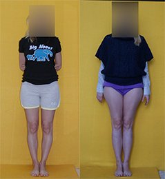 Vor und nach der Operation zur Beinverlängerung in Kombination mit einer Deformitätenkorrektur)