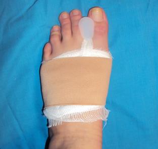 Postoperative Fußversteifung