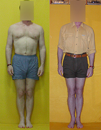 Patient before and after limb lengthening surgery